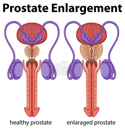 Ilustración de Dentro del sistema reproductor masculino con ilustración de agrandamiento de próstata - Imagen libre de derechos