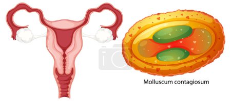 Ilustración de Infección vaginal bacterias concepto ilustración - Imagen libre de derechos