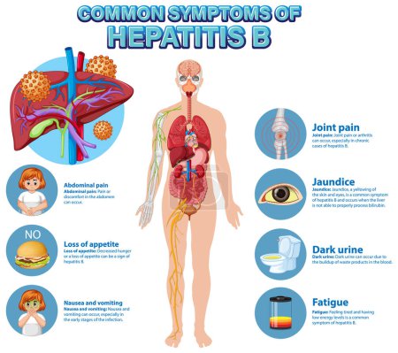Illustration for Informative poster of common symptoms Hepatitis B illustration - Royalty Free Image