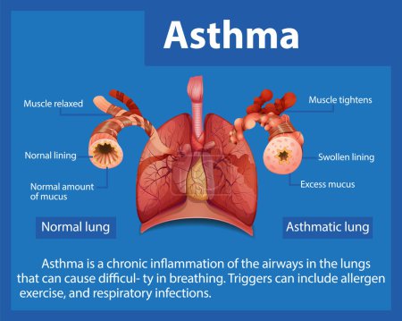 Ilustración de Una infografía informativa que compara los pulmones normales y asmáticos - Imagen libre de derechos