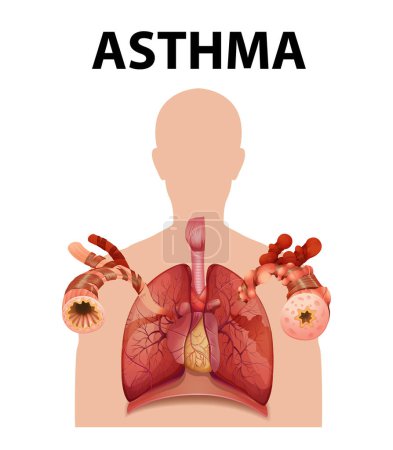Ilustración de Ilustración comparando pulmones humanos en condiciones normales y asma - Imagen libre de derechos