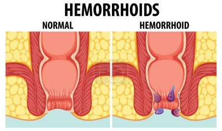 Illustration for Educational graphic illustrating the differences between normal and internal hemorrhoids - Royalty Free Image