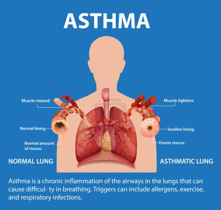 Ilustración de Infografía ilustrada que compara los pulmones humanos en condiciones normales y de asma - Imagen libre de derechos