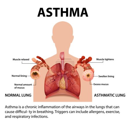 Ilustración de Ilustración que compara pulmones normales y asma para la educación médica - Imagen libre de derechos