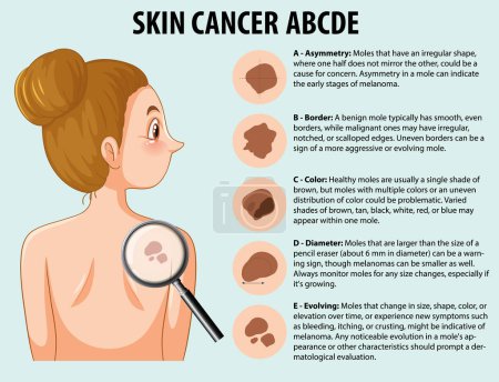 Ilustración de Infografía ilustrada que muestra el crecimiento anormal de las células de la piel en el cáncer de piel - Imagen libre de derechos