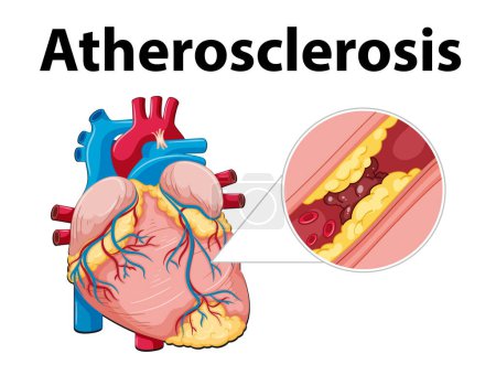 Ilustración de Infografía ilustrada sobre anatomía cardiaca y desarrollo de aterosclerosis - Imagen libre de derechos