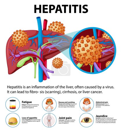 Ilustración de Ilustración del hígado con hepatitis y sus efectos en el cuerpo - Imagen libre de derechos