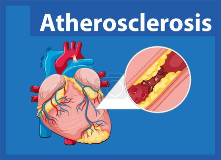 Ilustración de Aprenda sobre la salud del corazón y el desarrollo de la aterosclerosis en esta infografía educativa - Imagen libre de derechos