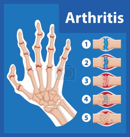 Illustration for Infographic illustrating stages of arthritis in human hand - Royalty Free Image