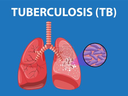 Photo for Illustration of human lung anatomy showcasing tuberculosis infection - Royalty Free Image