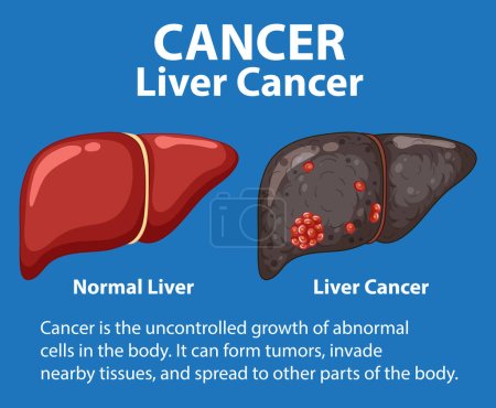 Photo for Infographic illustrating the differences between healthy and abnormal liver cell growth - Royalty Free Image