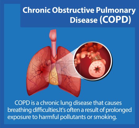 Photo for Illustrated infographic explaining chronic obstructive pulmonary disease in human anatomy - Royalty Free Image