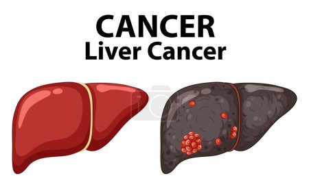 Illustration for Infographic illustrating the anatomy of liver cancer cells - Royalty Free Image