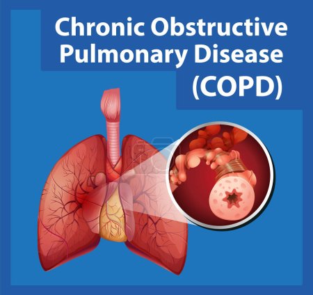 Ilustración de Infografía ilustrada que explica la enfermedad pulmonar obstructiva crónica en la anatomía humana - Imagen libre de derechos