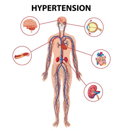 Téléchargez les illustrations : Guide illustré de l'impact de l'hypertension sur le corps humain - en licence libre de droit