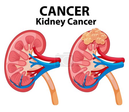 Ilustración de Infografía ilustrada que muestra el proceso de desarrollo del cáncer en el riñón humano - Imagen libre de derechos