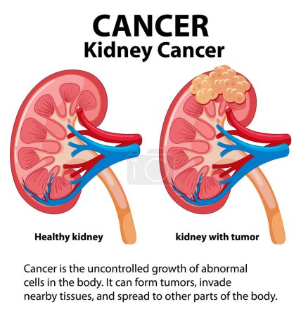 Ilustración de Infografía que ilustra el crecimiento celular anormal en el riñón que conduce al cáncer - Imagen libre de derechos