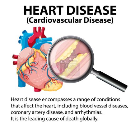 Téléchargez les illustrations : Illustration représentant la maladie et les maladies cardiaques dans une infographie médicale - en licence libre de droit