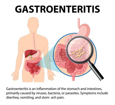 Ilustración de Una infografía que ilustra la gastroenteritis, sus causas y síntomas - Imagen libre de derechos