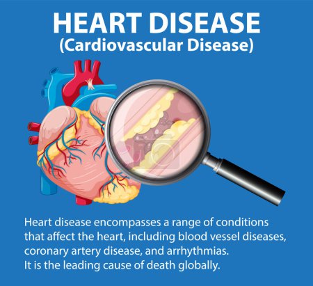 Téléchargez les illustrations : Infographie illustrée représentant la maladie et les maladies cardiaques en anatomie médicale - en licence libre de droit