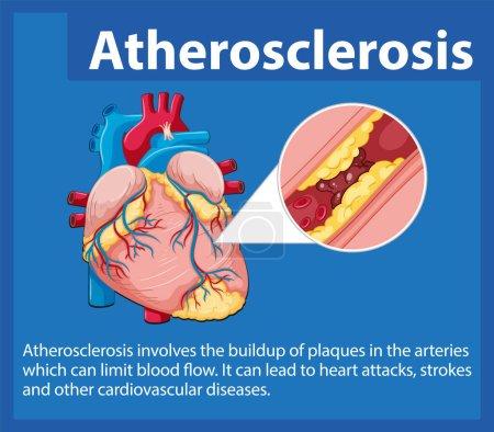 Ilustración de Aprenda sobre la salud del corazón y el desarrollo de la aterosclerosis en esta infografía educativa - Imagen libre de derechos