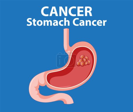 Ilustración de Una infografía detallada de dibujos animados que muestra el cáncer de estómago y el crecimiento anormal de las células - Imagen libre de derechos