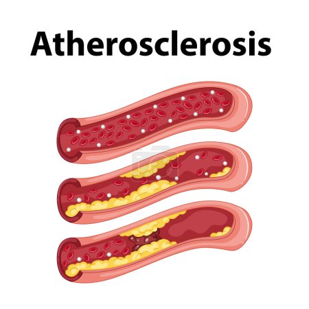 Ilustración de Aprender sobre el desarrollo de la aterosclerosis y su impacto en la salud del corazón - Imagen libre de derechos