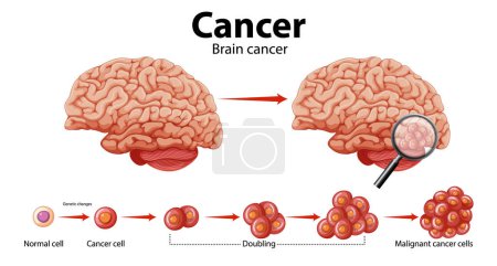 Téléchargez les illustrations : Guide illustré du cancer du cerveau et de la croissance cellulaire anormale - en licence libre de droit