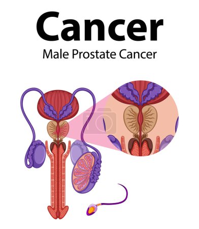 Illustration for Infographic illustrating male prostate cancer and abnormal cell growth - Royalty Free Image