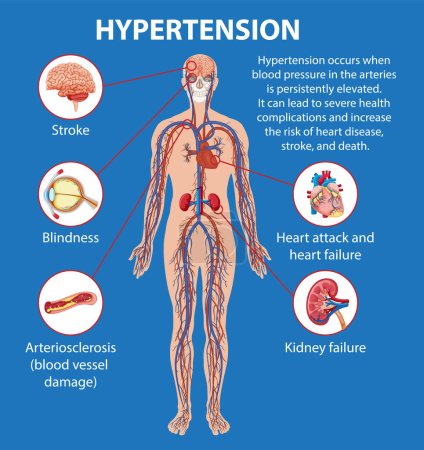Photo for Illustrated infographic explaining how hypertension impacts various parts of the human body - Royalty Free Image