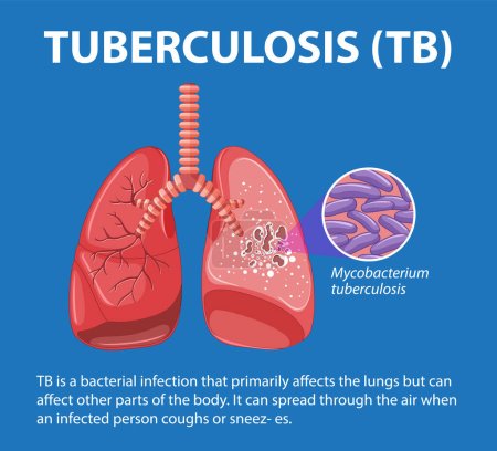 Illustration for Illustrated infographic depicting the medical education of human lung anatomy with tuberculosis - Royalty Free Image