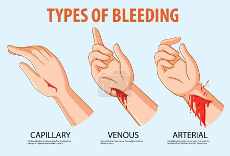 Ilustración de Ilustración de dibujos animados vectoriales que muestran varios tipos de sangrado en la mano - Imagen libre de derechos