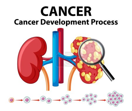 Ilustración de Infografía ilustrada que muestra el proceso de desarrollo del cáncer en el riñón humano - Imagen libre de derechos