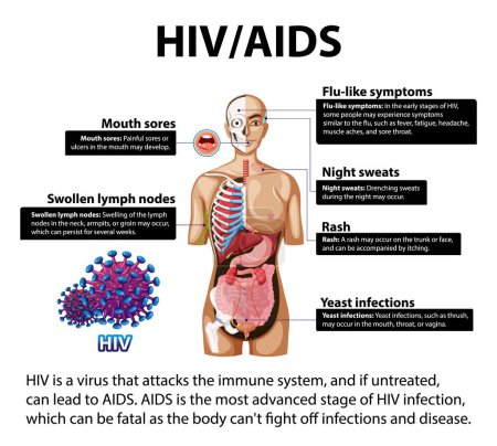 Illustration for Illustrated infographic depicting the impact of HIV/AIDS on the body - Royalty Free Image