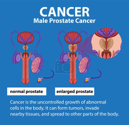 Illustration for Illustrated infographic highlighting differences between healthy and cancerous prostate - Royalty Free Image