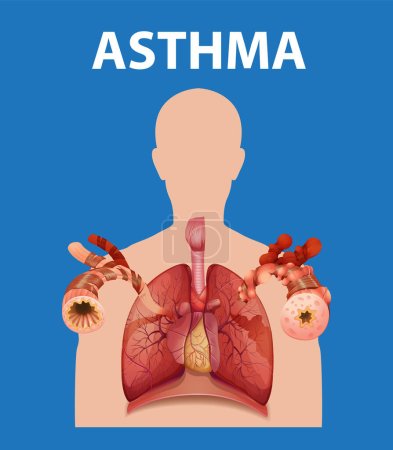 Eine informative Infografik, die normale und Asthma-Lungen im Kontext medizinischer Ausbildung vergleicht