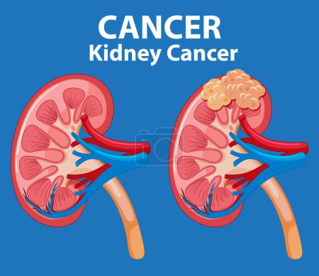 Illustration for Comparing healthy and tumor-infected kidneys in cancer development - Royalty Free Image