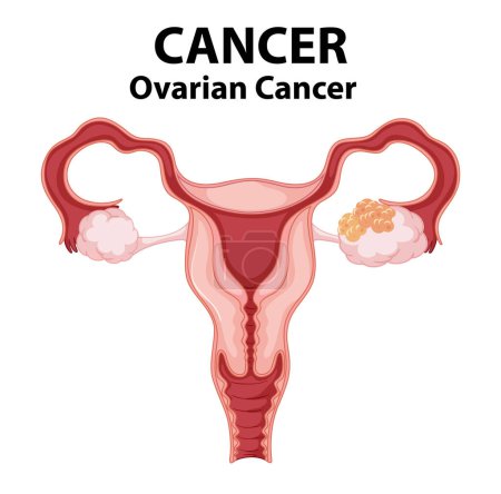 Illustration for An informative infographic illustrating the differences between healthy and cancerous ovaries in women - Royalty Free Image