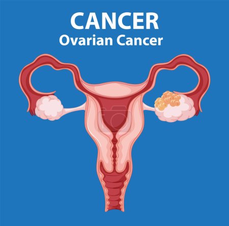 Téléchargez les illustrations : Une infographie informative illustrant les différences entre les ovaires normaux et cancéreux chez les femmes - en licence libre de droit