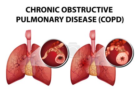 Ilustración de Ilustración que muestra los aspectos médicos de la enfermedad pulmonar obstructiva crónica - Imagen libre de derechos