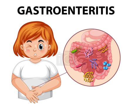 Ilustración de Ilustración de una mujer que sufre de gastroenteritis por infección e inflamación - Imagen libre de derechos