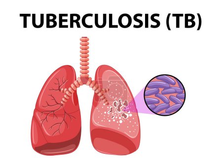 Ilustración de Infografía ilustrada que muestra la educación médica de la anatomía pulmonar humana con tuberculosis - Imagen libre de derechos
