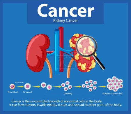 Téléchargez les illustrations : Infographie illustrée illustrant le processus de développement du cancer dans le rein humain - en licence libre de droit