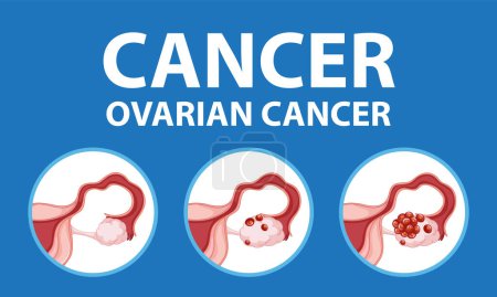 Téléchargez les illustrations : Représentation visuelle des différents stades du cancer de l'ovaire chez la femme - en licence libre de droit