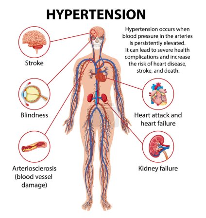 Illustration for Illustrated infographic explaining how hypertension impacts various parts of the human body - Royalty Free Image