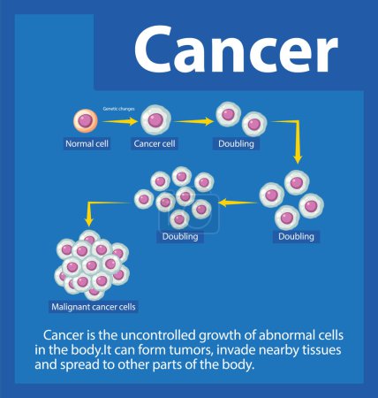 Téléchargez les illustrations : Comprendre le développement et le traitement des cellules cancéreuses grâce à une infographie - en licence libre de droit