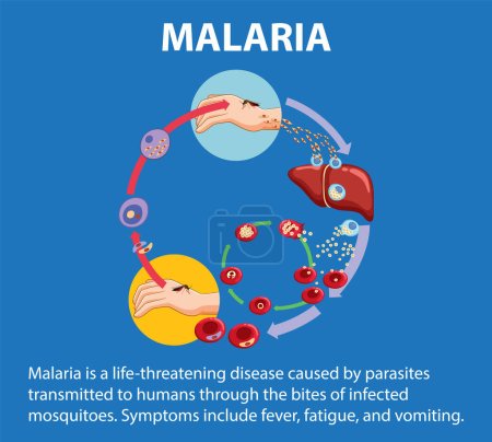 Ilustración de Infografía ilustrada que muestra las etapas de transmisión del parásito de la malaria - Imagen libre de derechos