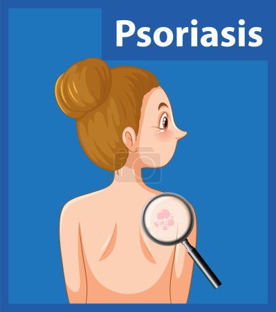 A vector cartoon illustration depicting a person with psoriasis, a skin disease