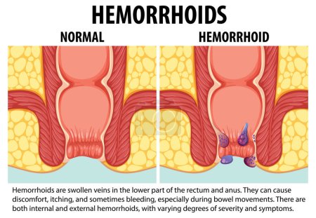 Illustration for Learn about the differences between normal and internal hemorrhoids through an educational infographic - Royalty Free Image