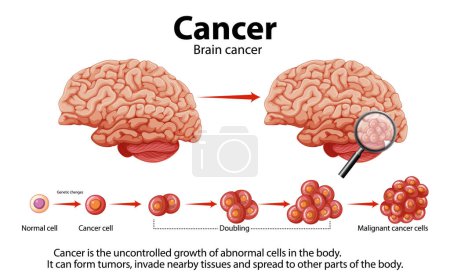 Illustration depicting brain cancer and abnormal cell growth